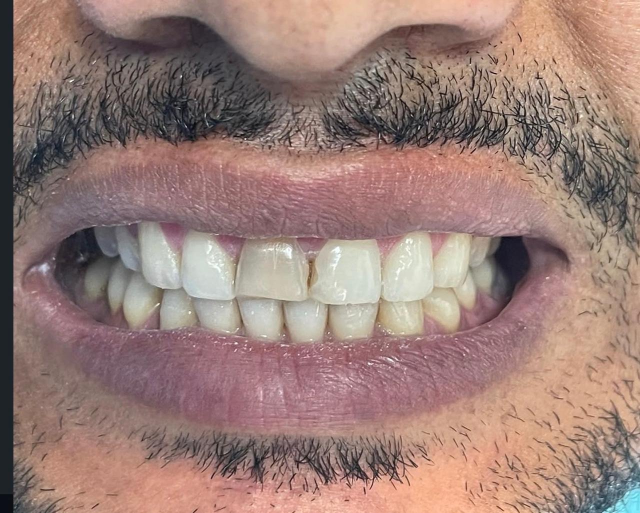 Caso de blanqueamiento dental, foto 1