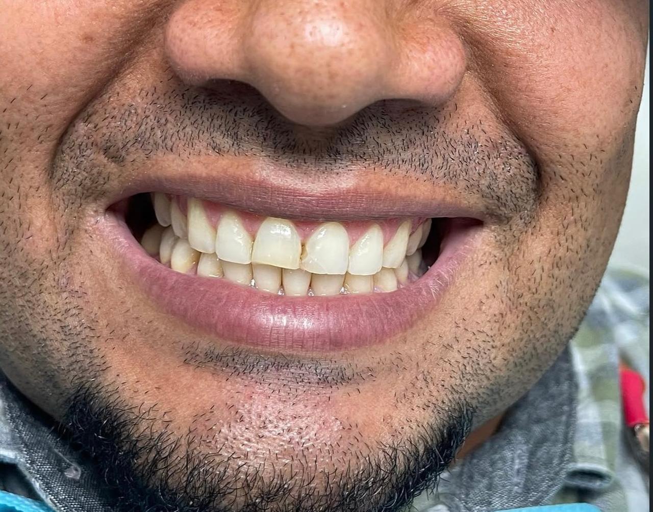 Caso de blanqueamiento dental, foto 2