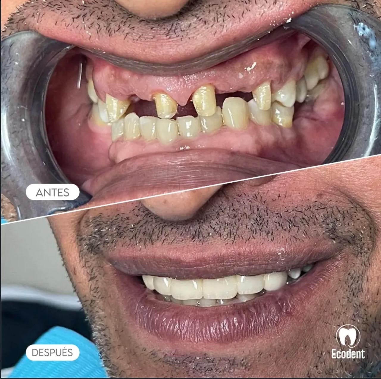 Caso de implante dental 1