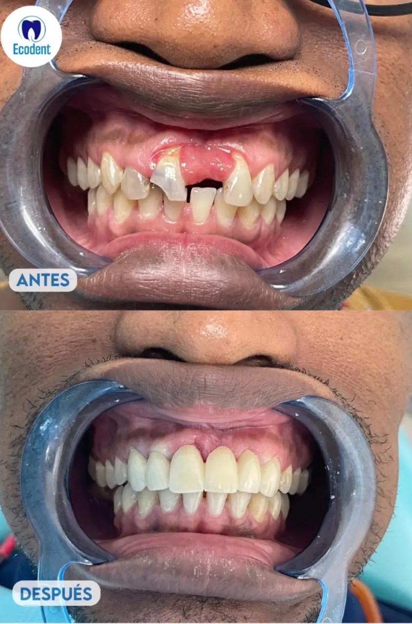 Caso de implante dental 2
