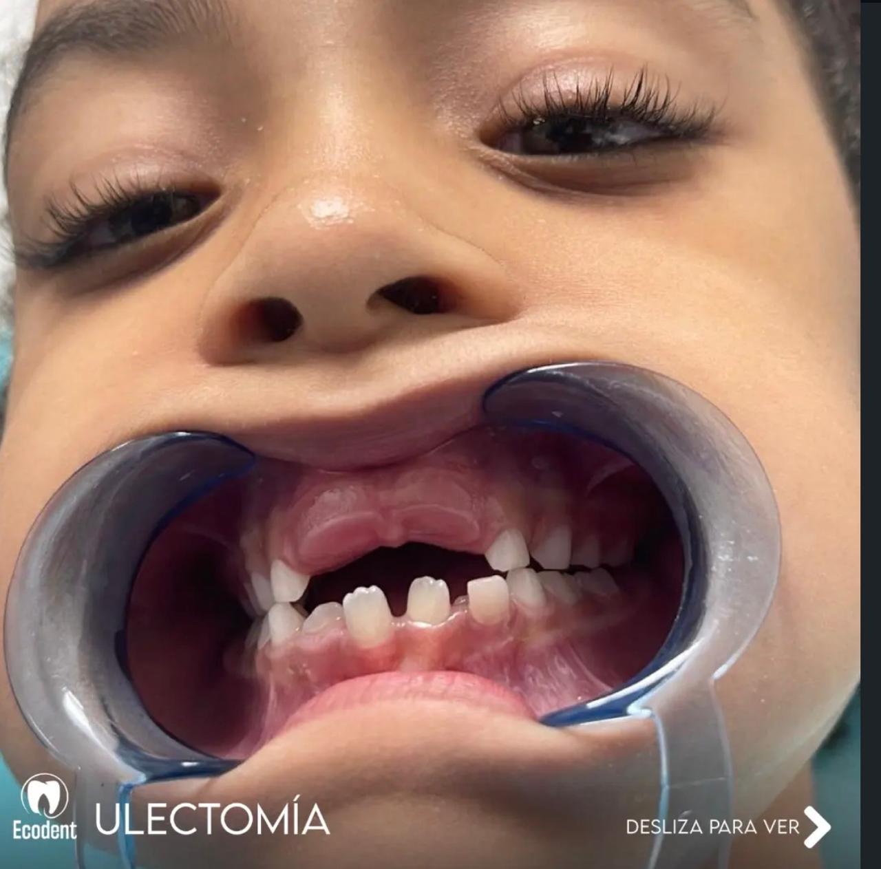 Caso de ulectomía, foto 1