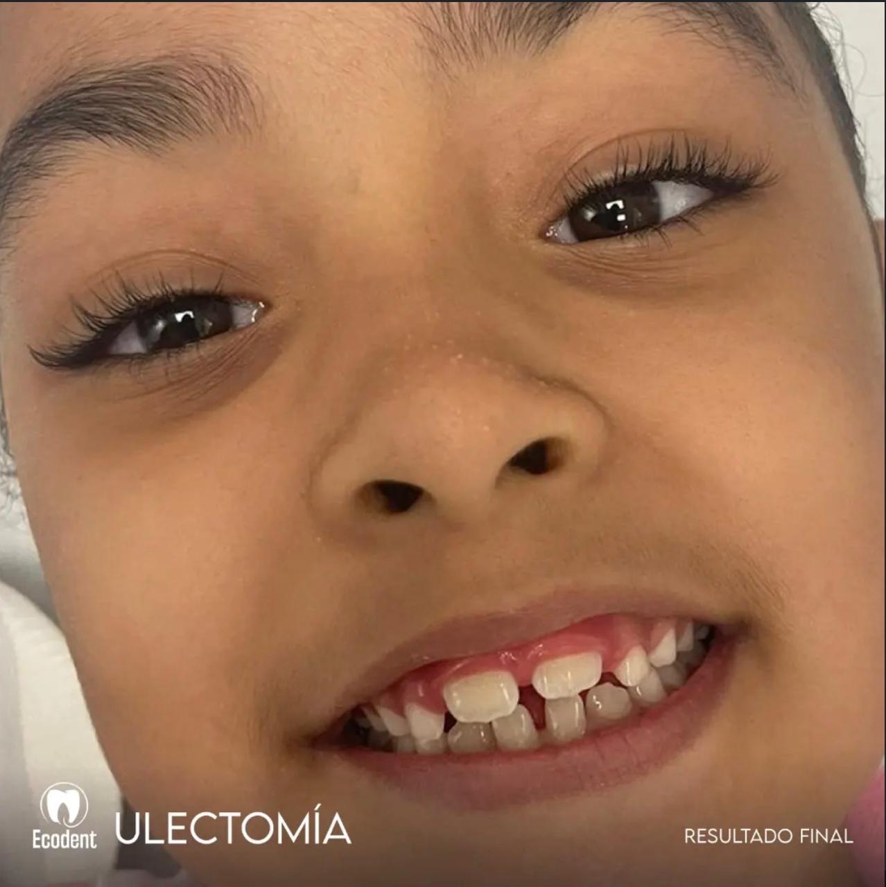 Caso de ulectomía, foto 2